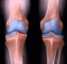 Asanas pentru genunchi cu artroză